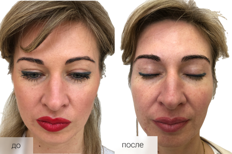 До / После