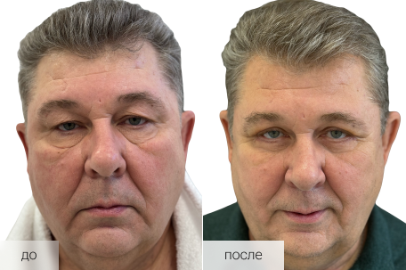 До / После